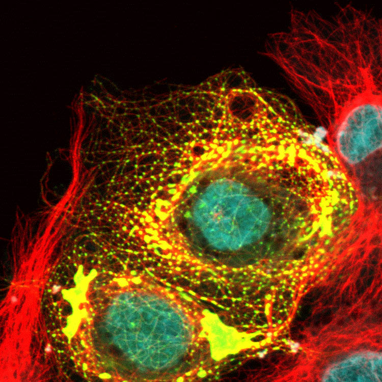 COS-7 cells expressing abnormal form of microtubule plus-end binding protein. MTs = red, yellow = plus-end binding protein